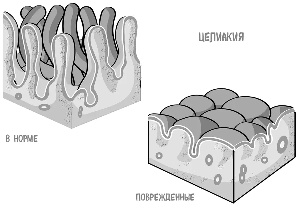 Воспаленная слизистая оболочка тонкого кишечника восстановится если исключить - фото 91