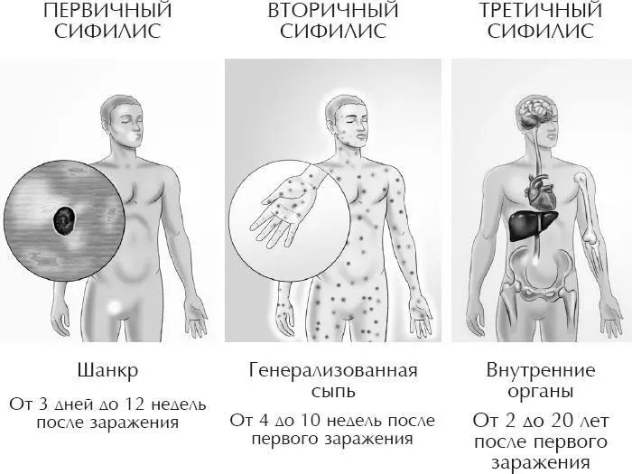 СТАДИИ СИФИЛИСА Болезни связанные с сексуальной распущенностью в ходе истории - фото 25