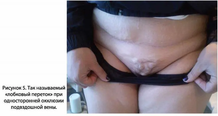 Наиболее тяжелое проявление посттромботической болезни трофические язвы - фото 6