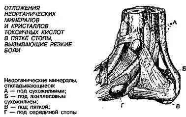 А может быть вам мешают ходить образовавшиеся на ногах наросты которые - фото 40