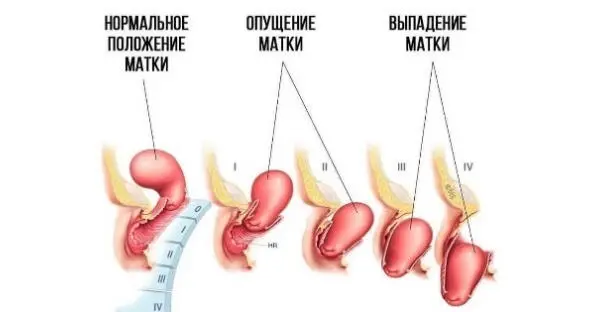В этом случае матка может повлечь за собой и опущение мочевого пузыря который - фото 2