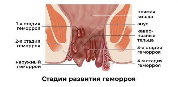 При этом заболевании наблюдается расширение одного или более кровеносных - фото 3