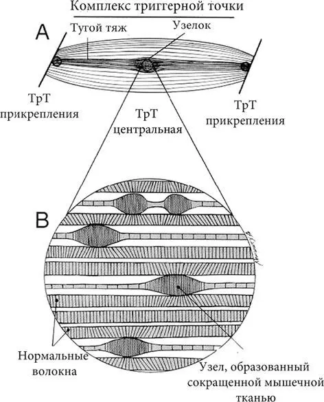 Рис 31 Комплекс триггерной точки Схематичное изображение комплекса ТрТ - фото 2