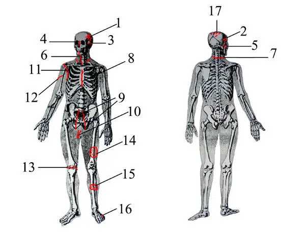 Анатомическая схема с указанием телесных повреждений причиненных Герде - фото 3
