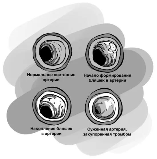 Ишемическая болезнь сердца и инсульт две самые распространенные причины - фото 18