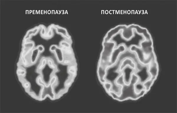 РИСУНОК 1 МЕНОПАУЗА АКТИВНОСТЬ МОЗГА ДО И ПОСЛЕ Время тоже указывает на - фото 1