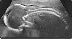 Рис 8 Зародыш в утробе матери Лидирующая спираль идущая по передней - фото 14