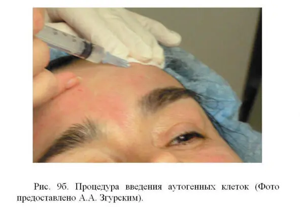 Поверхность кожи в которую вводятся клетки обрабатывается стерилизующими - фото 12