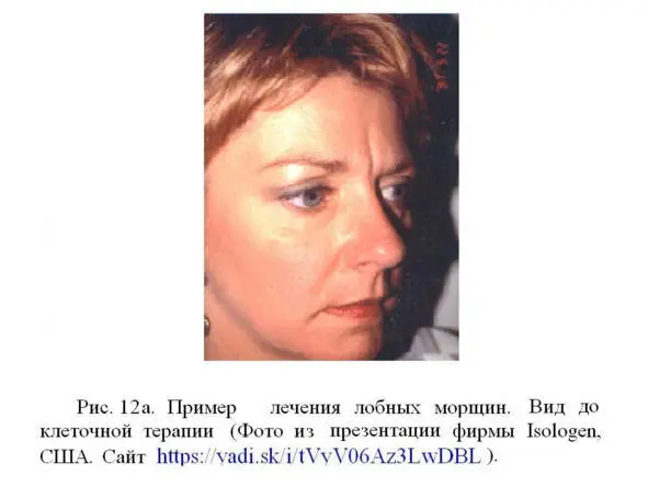 Некоторые специалисты пришли к заключению что лечение морщин с помощью - фото 17