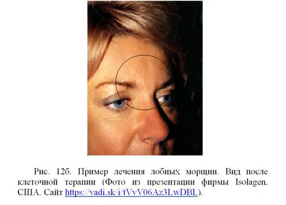 Некоторые специалисты пришли к заключению что лечение морщин с помощью - фото 18