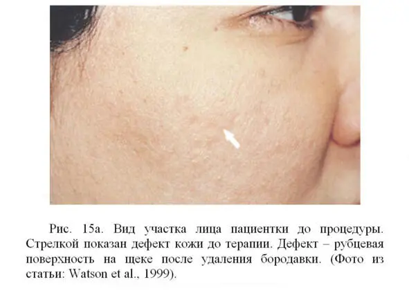 КРИОХРАНИЛИЩЕ После применения клеточной терапии часть клеток может оказаться - фото 24