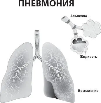 Среди ученых всего мира шел долгий спор существует вирусная пневмония или ее - фото 14
