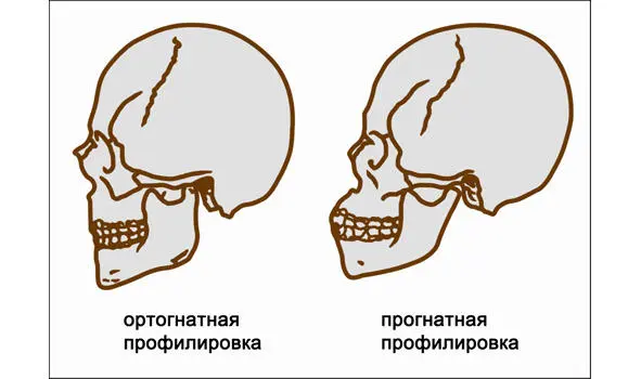 Варианты профилировки лица Ортогнатизм как и остальные типы вертикальной - фото 58