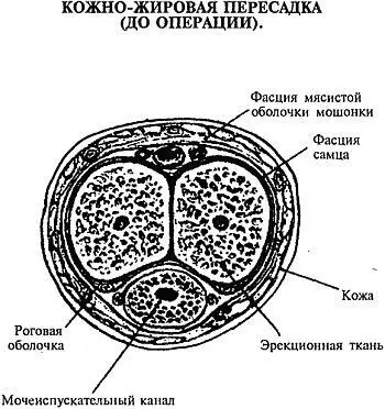 Среднее утолщение в результате осуществления кожножировой пересадки равняется - фото 37