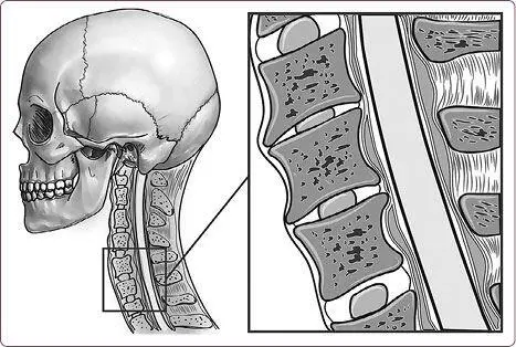 Рис 5 Межпозвоночные диски шейного отдела позвоночника Бывает наоборот - фото 10