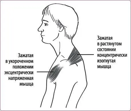 Рис 14 Дисбаланс мышц при сутулости А шея казалось бы вовсе не короткая - фото 19