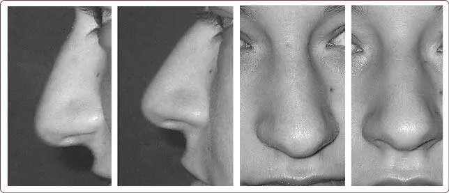 Рис 24 Слева нос до коррекции справа после То же скопление лимфы - фото 29