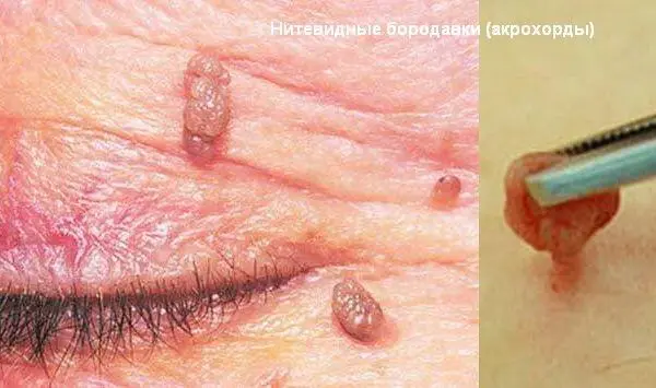 Каждый год у миллионов людей развивается заболевание кожи Часто это состояние - фото 1