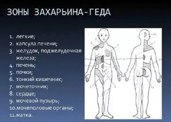 Рис 5 Рефлекторные зоны ЗахарьинаГеда отражают их связь с внутренними - фото 7