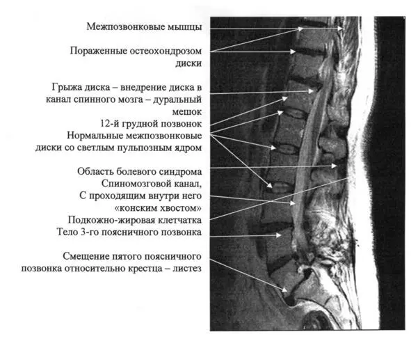 Рис 38 МРТ снимок поясничного отдела позвоночника Именно в этой области - фото 17