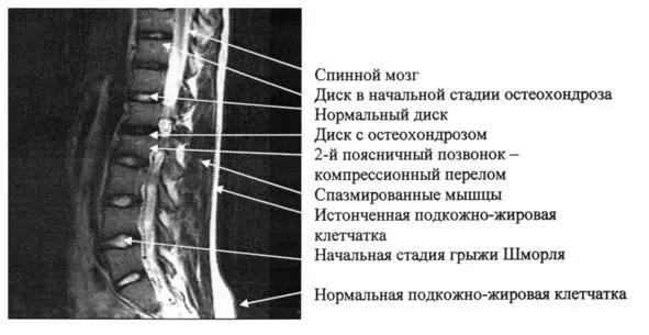 Рис 311 МРТ снимок поясничного отдела позвоночника пациентки 23 лет - фото 20
