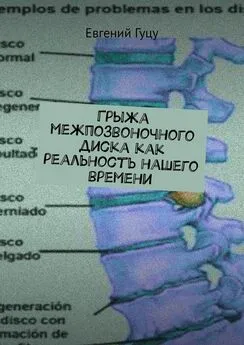 Евгений Гуцу - Грыжа межпозвоночного диска как реальность нашего времени