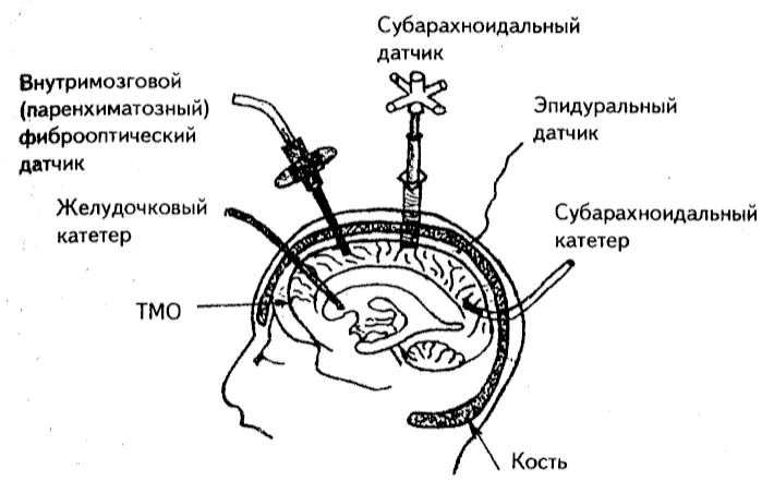 Рис 1 Методы мониторинга внутричерепного давления Спинномозговая жидкость - фото 2