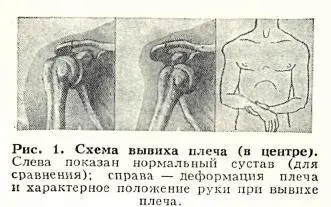 С целью профилактики привычных вывихов следует тренировать окружающие сустав - фото 3