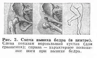 Первая помощь при вывихе бедра шинирование возможно только стандартными - фото 5