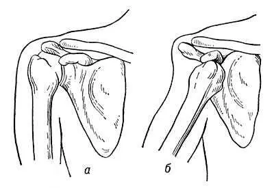 Вывих а нормальный плечевой сустав правый б вывих правого плеча Вывод - фото 26