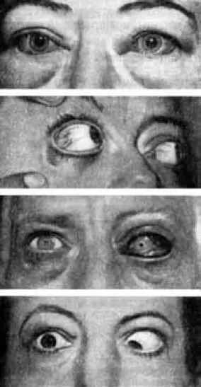 Рис 7 Офтальмопатия Выпячивание глазного яблока и выход его из орбиты - фото 15