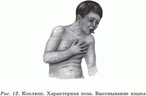 В периоде разрешения 23 недели кашель теряет свой типичный характер - фото 21
