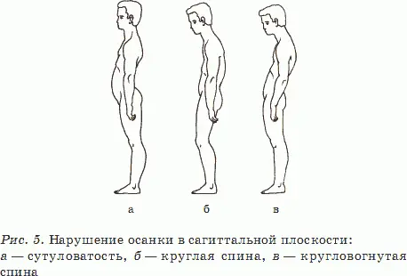 а сутуловатость увеличение грудного кифоза выгнутости и уменьшение - фото 5