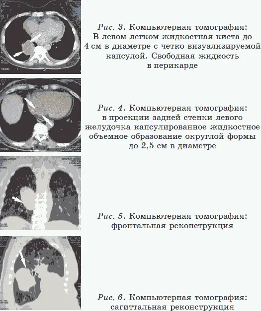На контрольной компьютерной томографии через 6 месяцев элементы обызвествления - фото 6