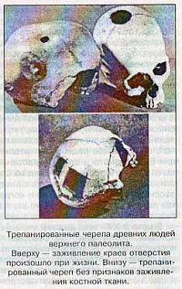 Трепанированные черепа древних людей верхнего палеолита Вверху заживление - фото 22