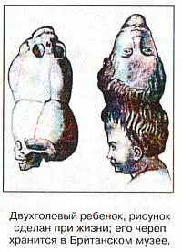 Двухголовый ребёнок рисунок сделан при жизни его череп хранится в Британском - фото 46