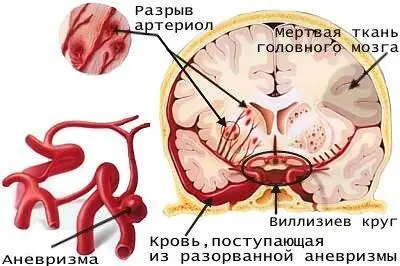 Инсульт возникает тогда когда кровеносный сосуд доставляющий в головной мозг - фото 9