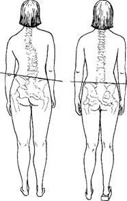 Позвоночник искривление и норма Различают лево и правосторонний сколиоз Он - фото 6