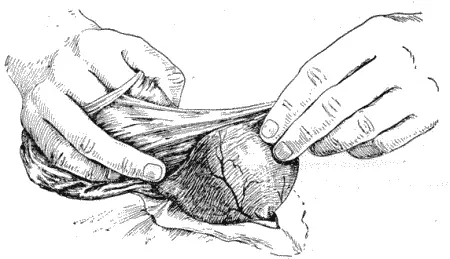 Рис 142 Удаление второго плода Рис 143 Двухэтажный серозномышечный шов - фото 145