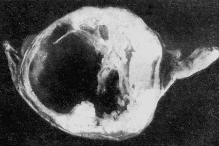 Рис 157 Фибросаркома матки Симптомы опухолей матки зависят от особенностей - фото 160