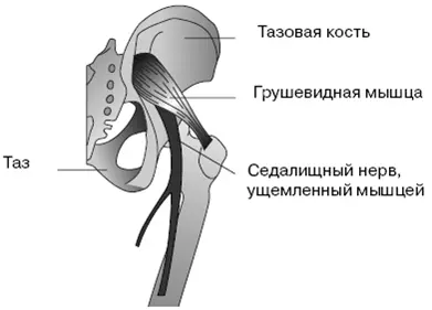 Рис 114 Синдром грушевидной мышцы Еще несколько лет назад считалось что - фото 17