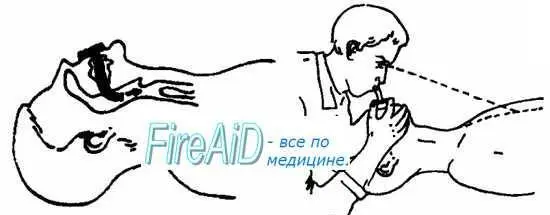 3 Во избежание инфицирования прикрыть рот пострадавшего специальной салфеткой - фото 3