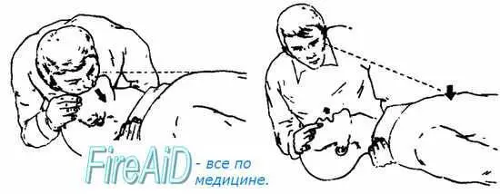 Для выполнения ИВЛнеобходимо зажать двумя пальцами крылья носа пострадавшего - фото 4