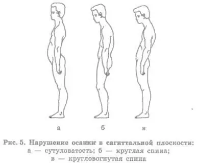кругловогнутая спина увеличение всех изгибов позвоночника а также угла - фото 5