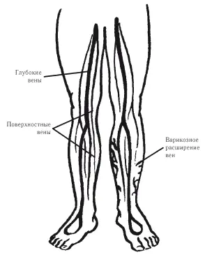 Рис 4 Варикозное расширение вен Несостоятельность клапанов проявляется - фото 4