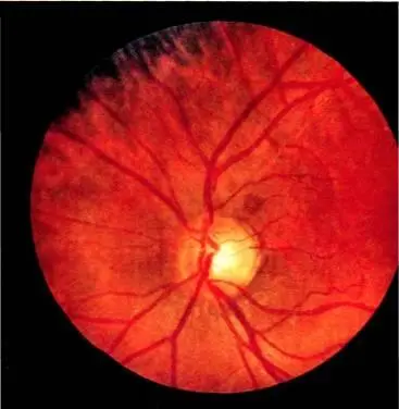 Рис 18 Офтальмолог рассматривая глазное дно видит нечто сходное с этим - фото 19