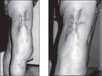 Рис 3Раны на 7й неделе лечения анолитом Следующие фотографии взяты из моего - фото 3
