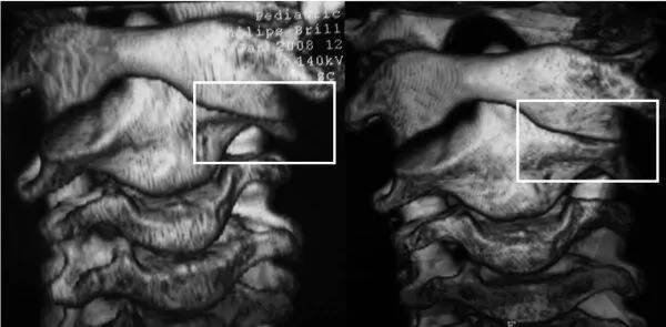 Рис 64Больной В 12 лет А 3D КТ реконструкция в первые часы от - фото 42