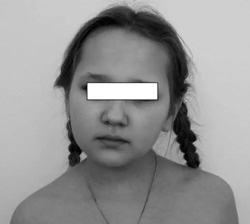 Рис 618Кривошея у пациентки 12лет с хроническим атлантоаксиальным - фото 57