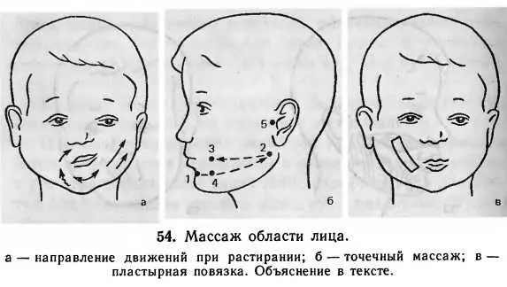 квадратной щечной мышц на стороне поражения там где сглажена носогубная - фото 30